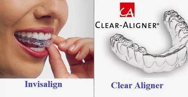 Chỉnh nha không mắc cài