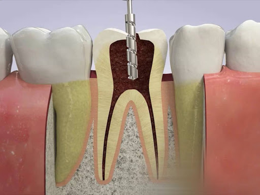 Điều trị tuỷ răng