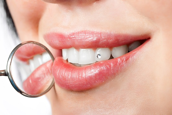 Gắn đá thẩm mỹ
