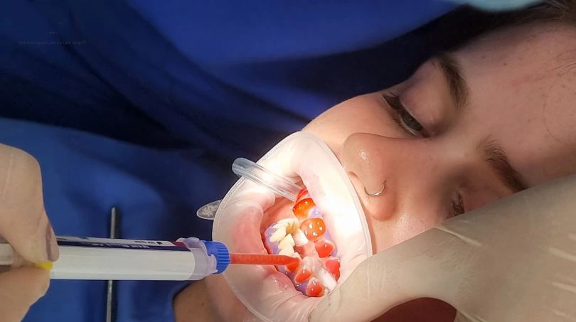 Công nghệ tẩy trắng răng bằng đèn led tại nha khoa